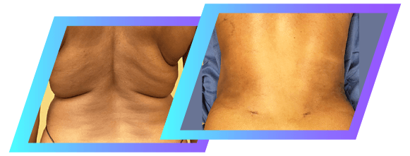 Liposuction of the Love Handles or Flanks  Reduce Sides, Love Handles and  Flanks with Liposuction 