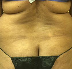 Flanks Before & After Patient #279