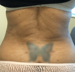 Flanks Before & After Patient #279