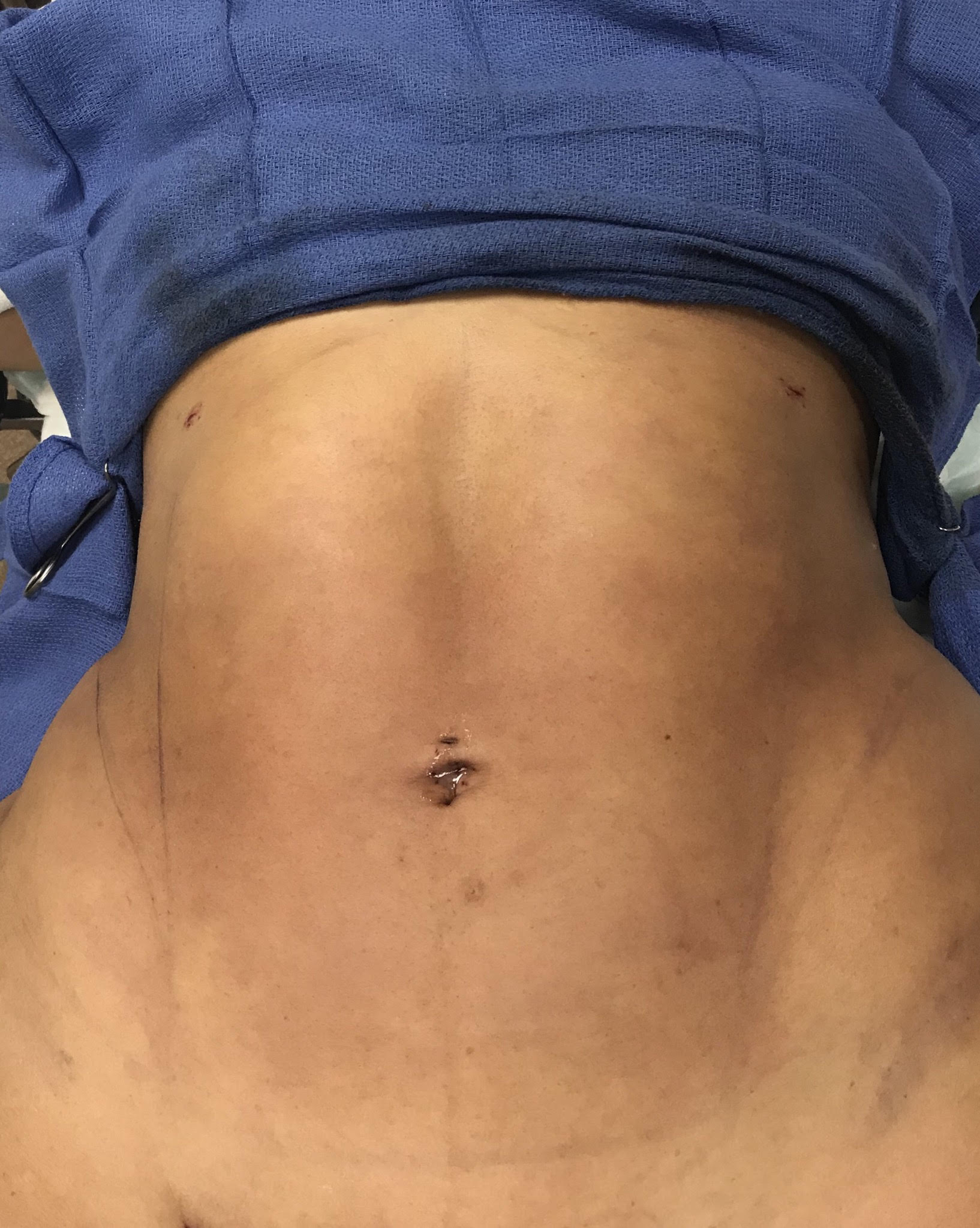 Abdomen Before & After Patient #475