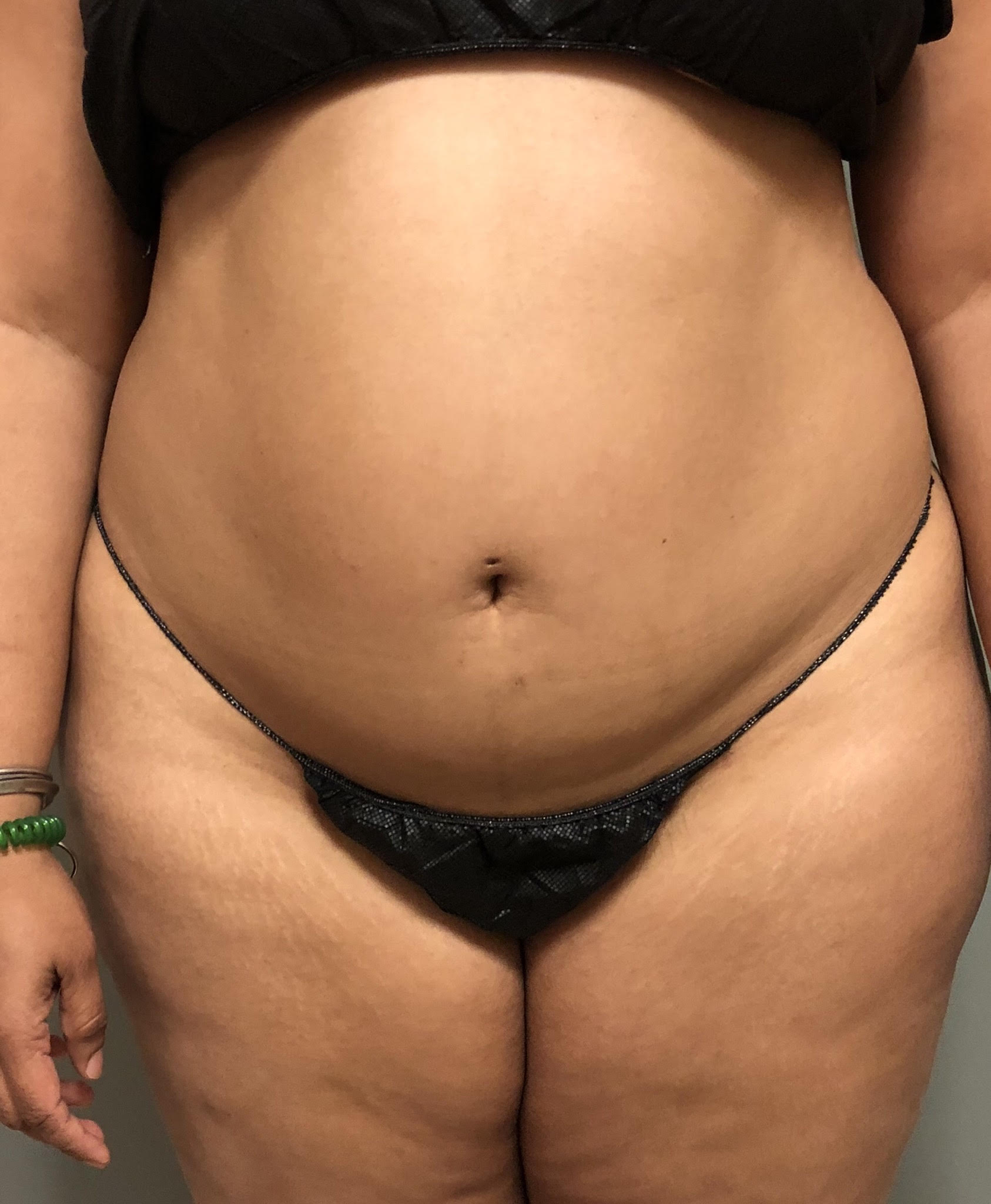 Abdomen Before & After Patient #475