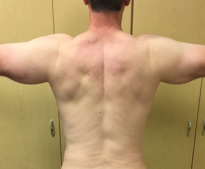 Arms Before & After Patient #230