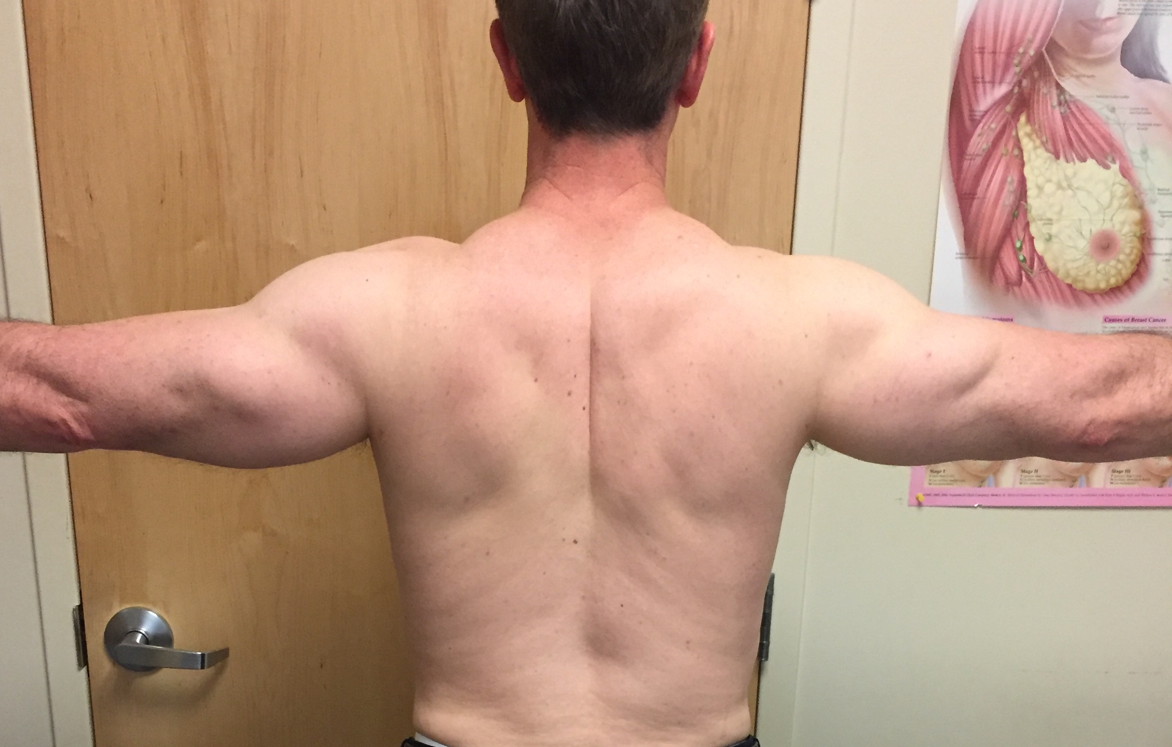 Arms Before & After Patient #230