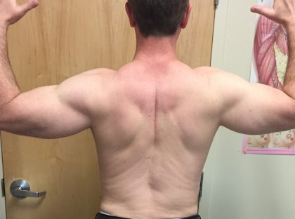 Arms Before & After Patient #230