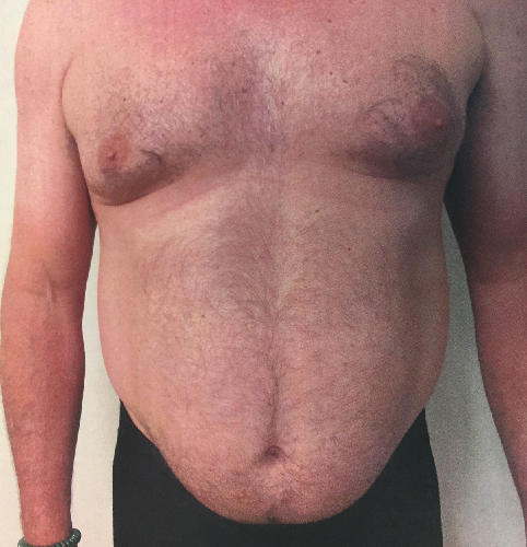Abdomen Before & After Patient #205