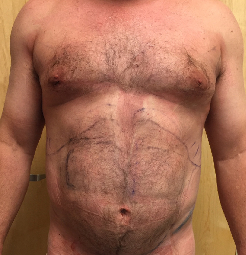 Abdomen Before & After Patient #205