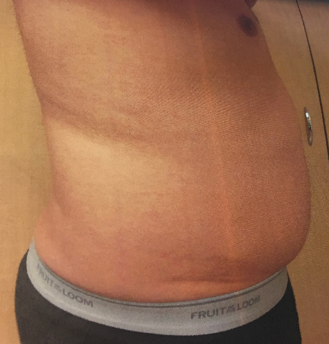 Abdomen Before & After Patient #208