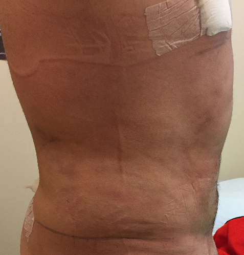 Abdomen Before & After Patient #208