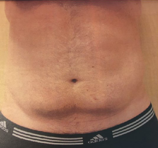 Abdomen Before & After Patient #212