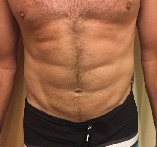 Abdomen Before & After Patient #212