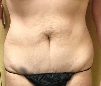 Abdomen Before & After Patient #173