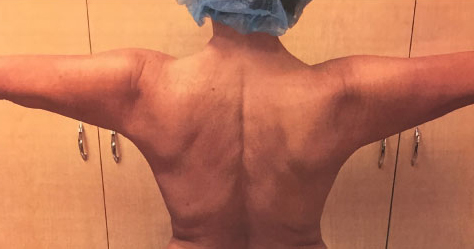 Arms Before & After Patient #237