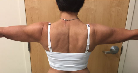 Arms Before & After Patient #237