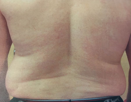 Flanks Before & After Patient #244