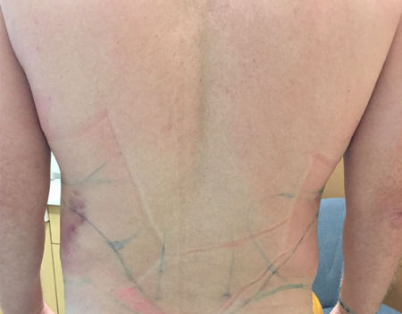 Flanks Before & After Patient #244