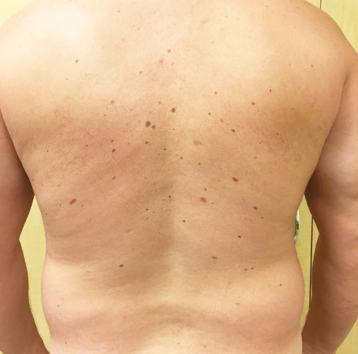 Flanks Before & After Patient #267