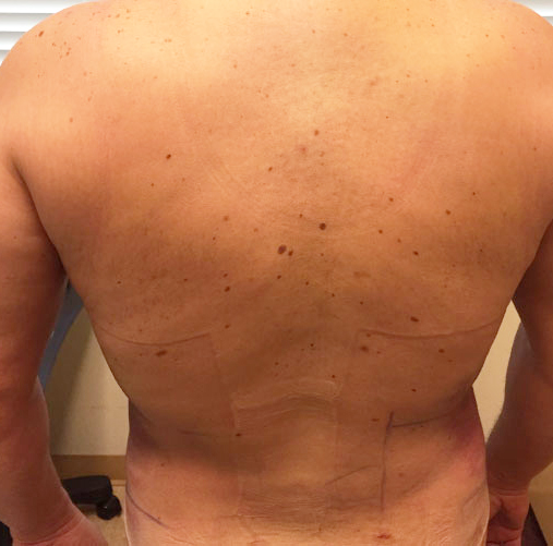 Flanks Before & After Patient #267