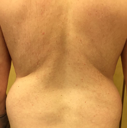 Flanks Before & After Patient #270