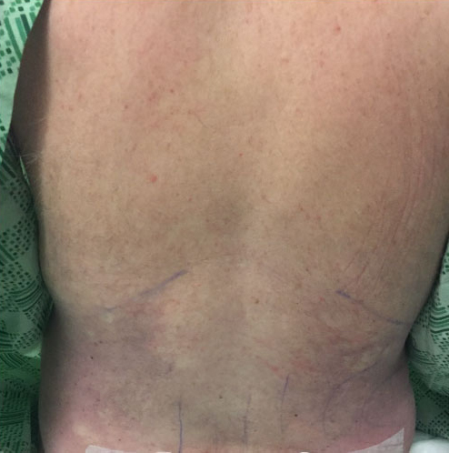 Flanks Before & After Patient #270