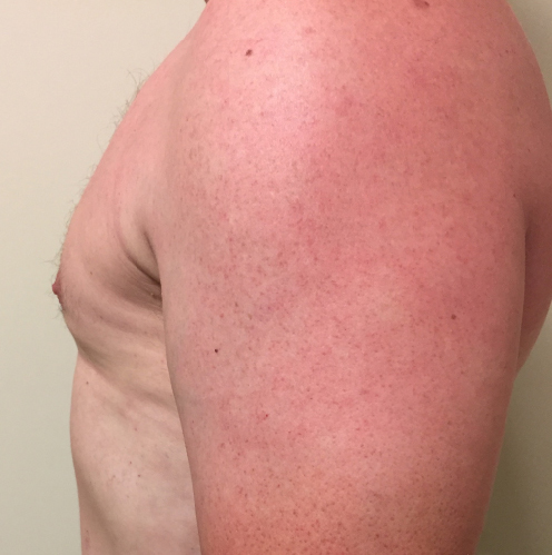 Chest Before & After Patient #298