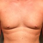 Chest Before & After Patient #301