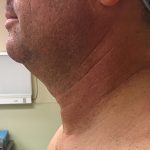 Neck Before & After Patient #311