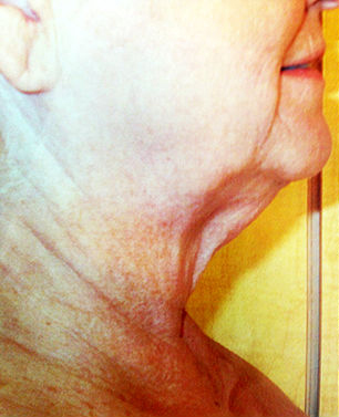 Neck Before & After Patient #316