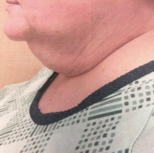 Neck Before & After Patient #331