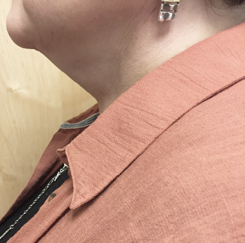 Neck Before & After Patient #331