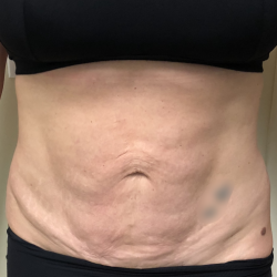 Renuvion Before & After Patient #217