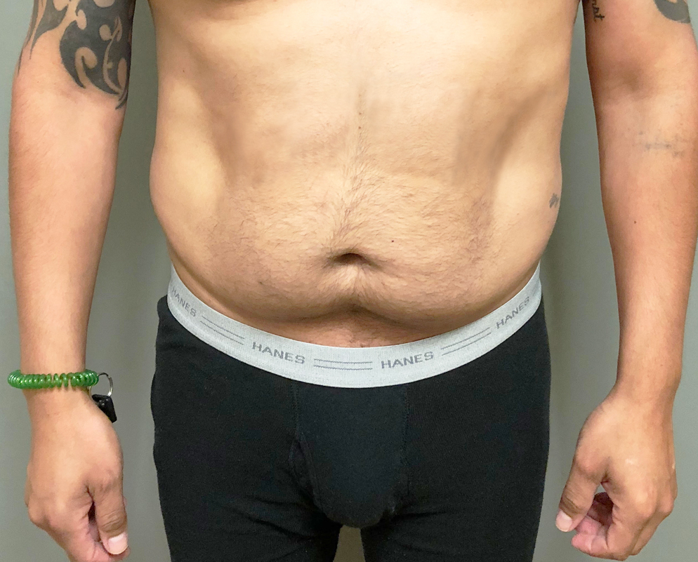 Abdomen Before & After Patient #485