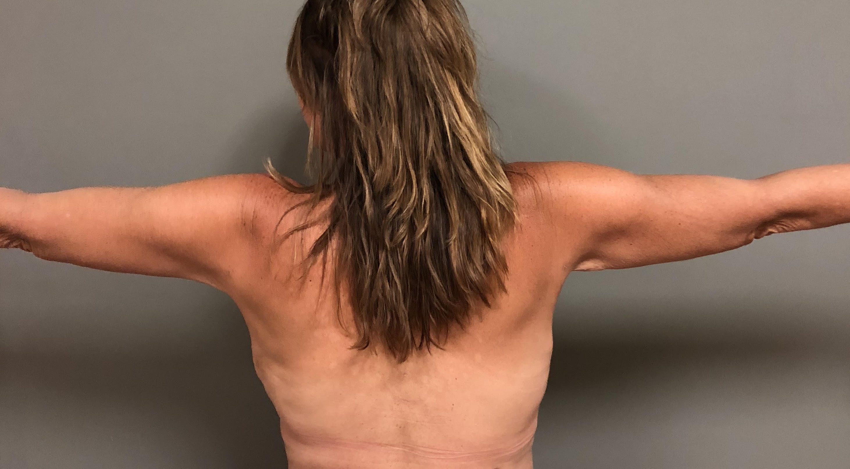 Arms Before & After Patient #480
