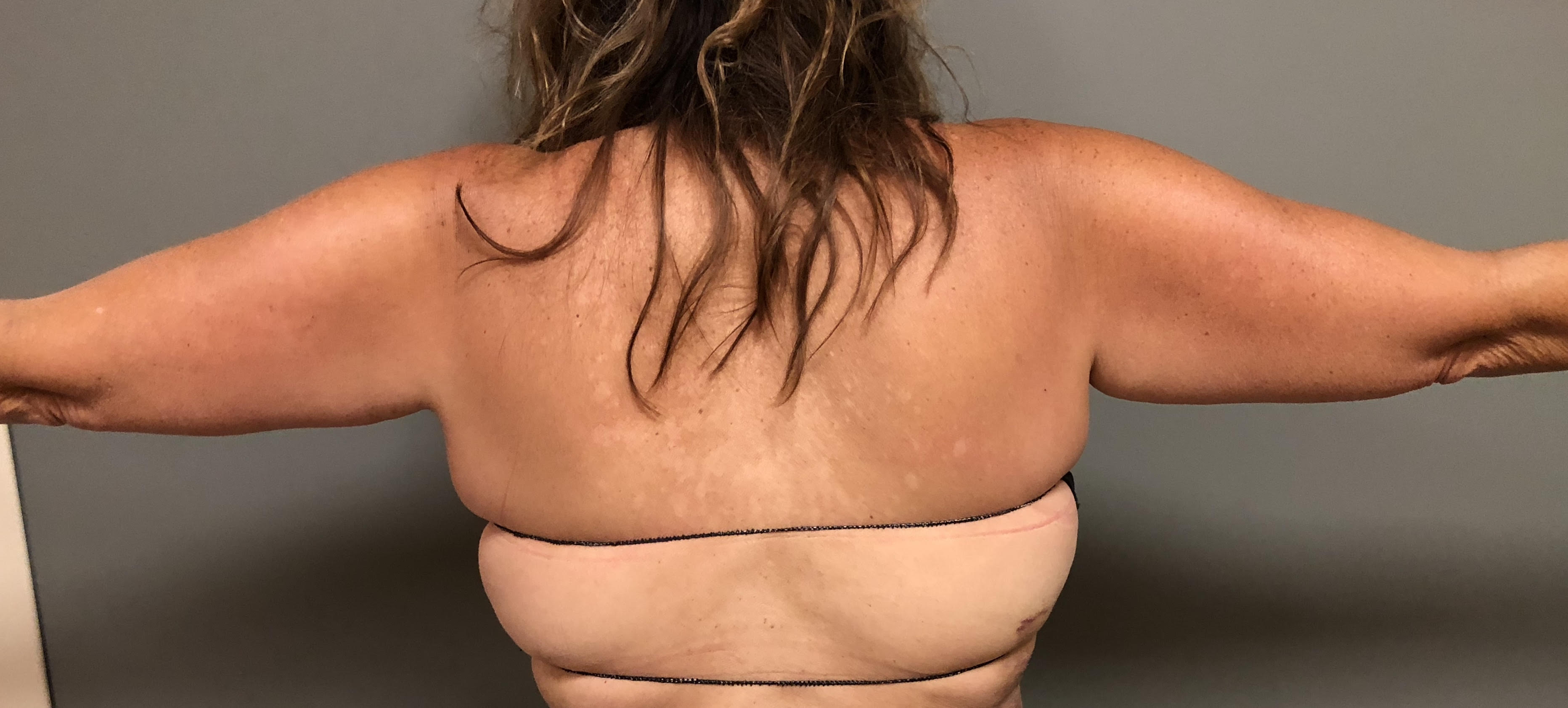 Arms Before & After Patient #480