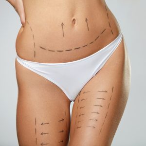 VASER Liposuction Sacramento