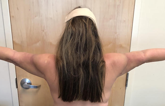 Arms Before & After Patient #532