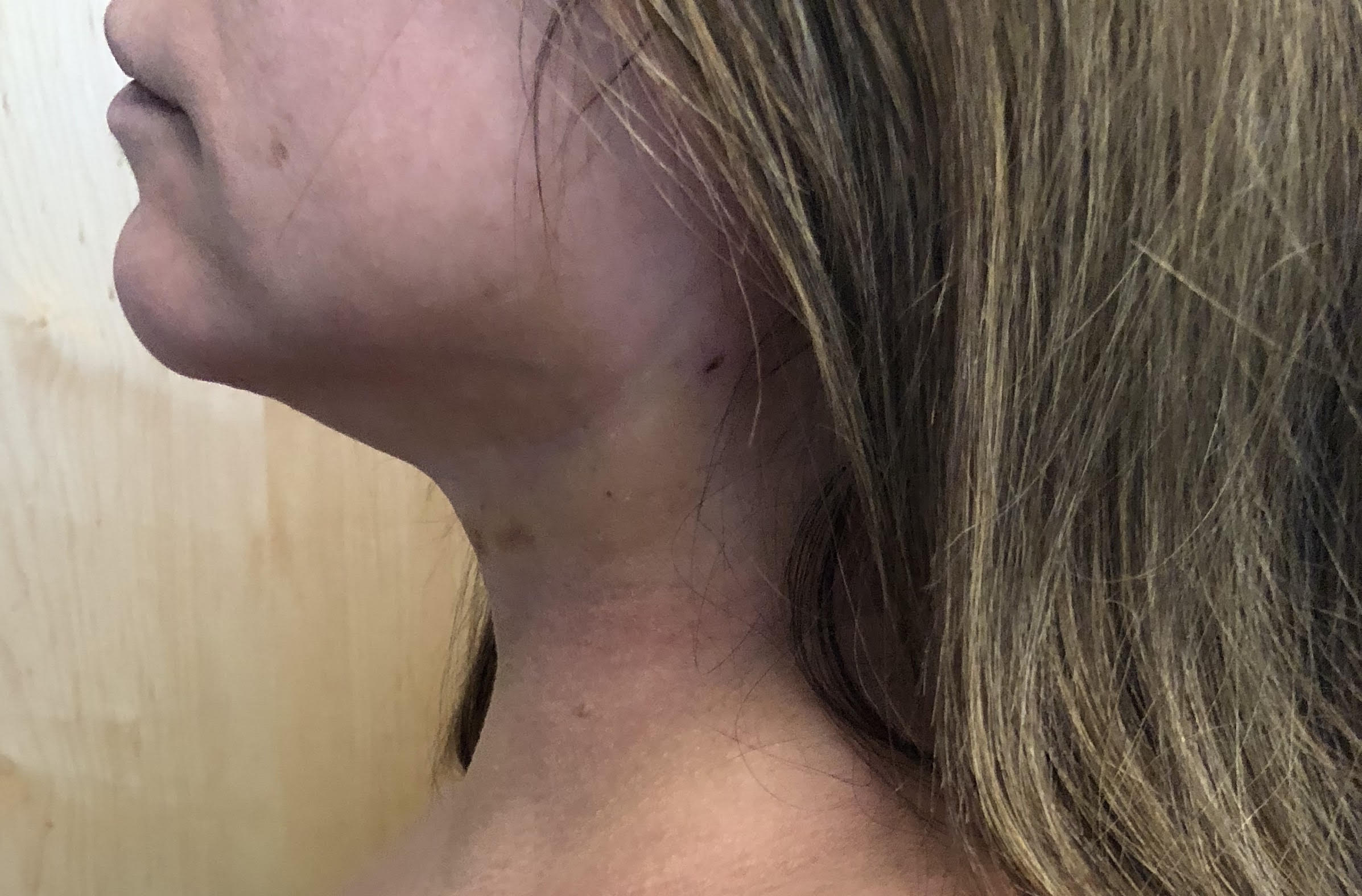 Neck Before & After Patient #537