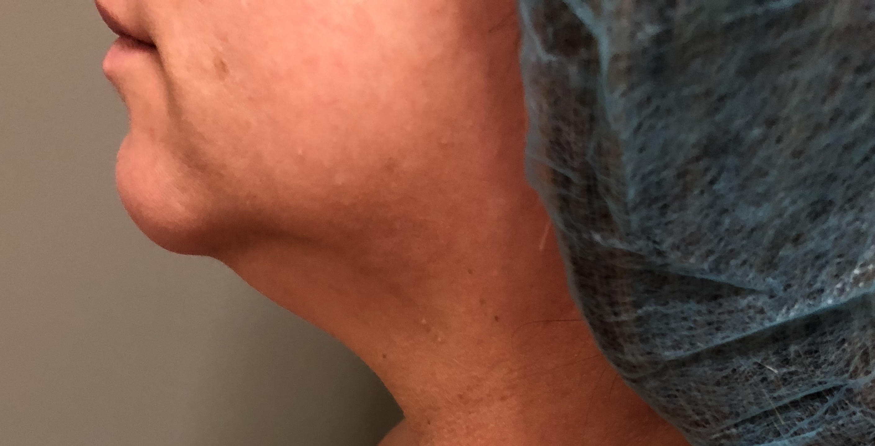 Neck Before & After Patient #537