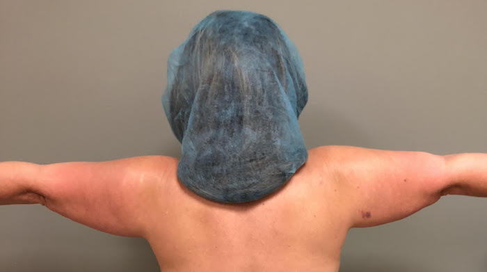 Arms Before & After Patient #532
