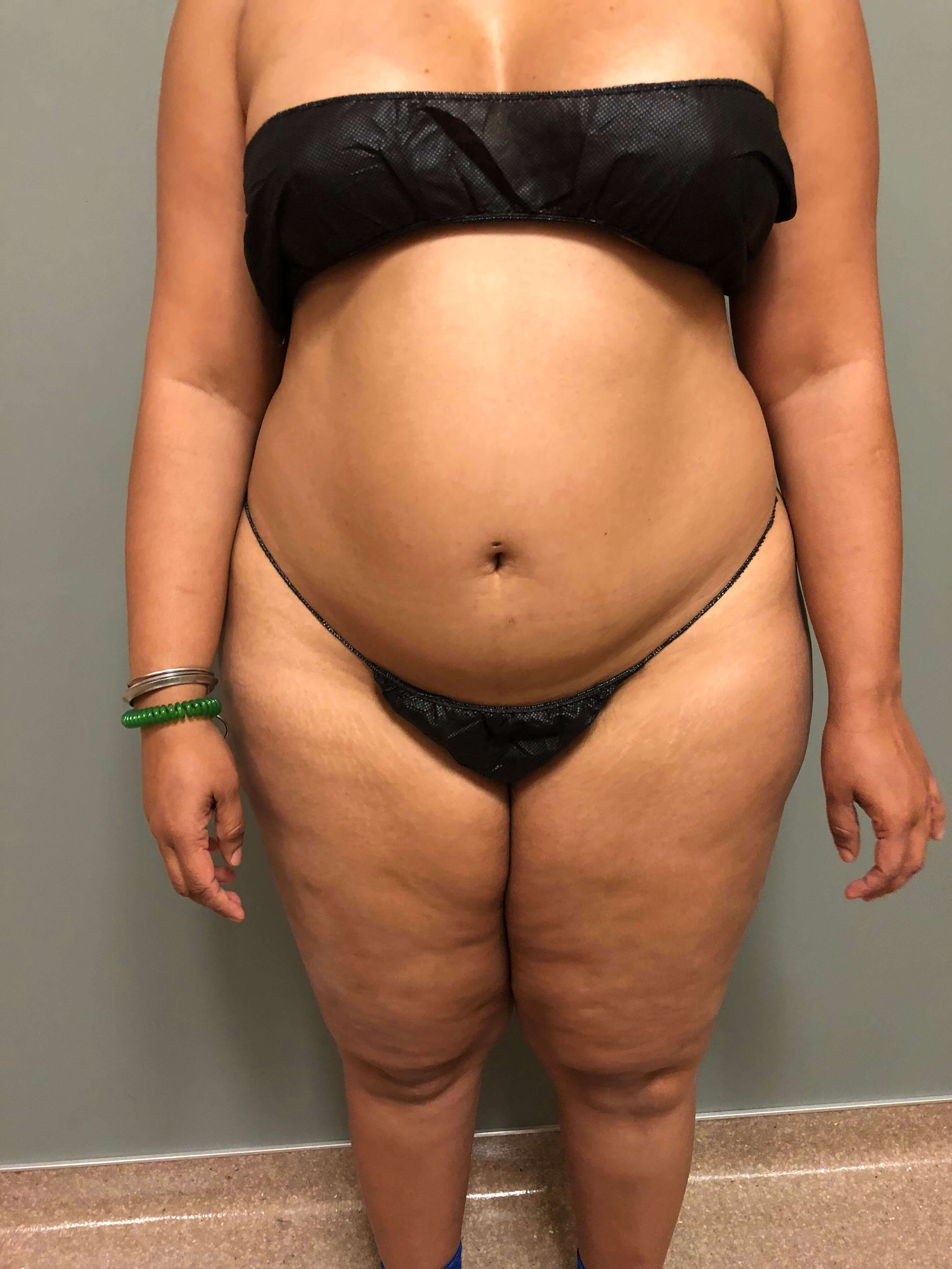 Abdomen Before & After Patient #589