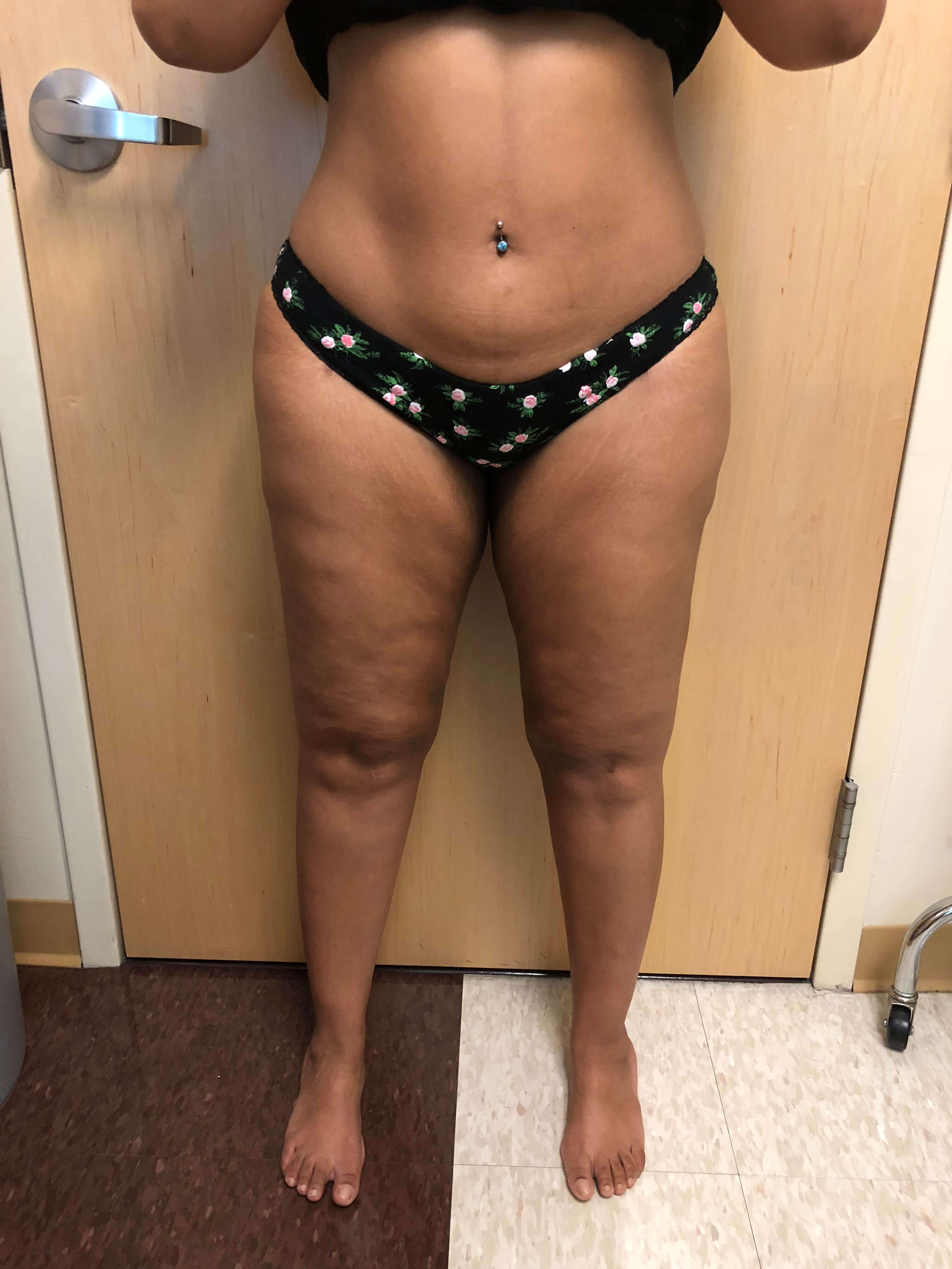 Abdomen Before & After Patient #589