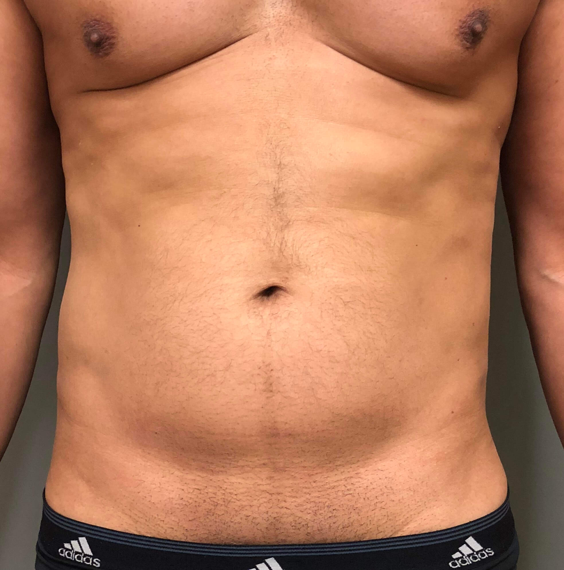 Abdomen Before & After Patient #583
