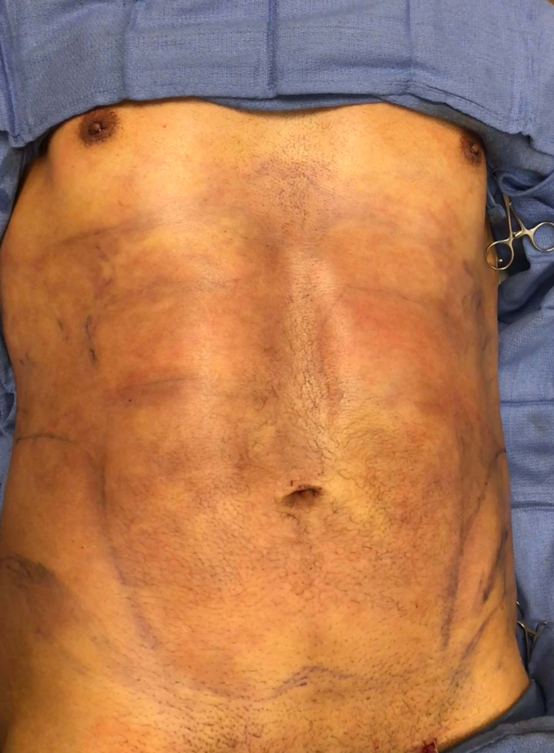 Abdomen Before & After Patient #583