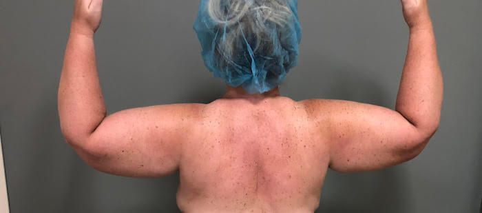 Arms Before & After Patient #576