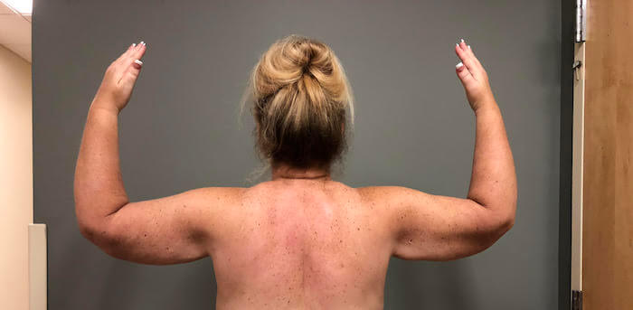 Arms Before & After Patient #576