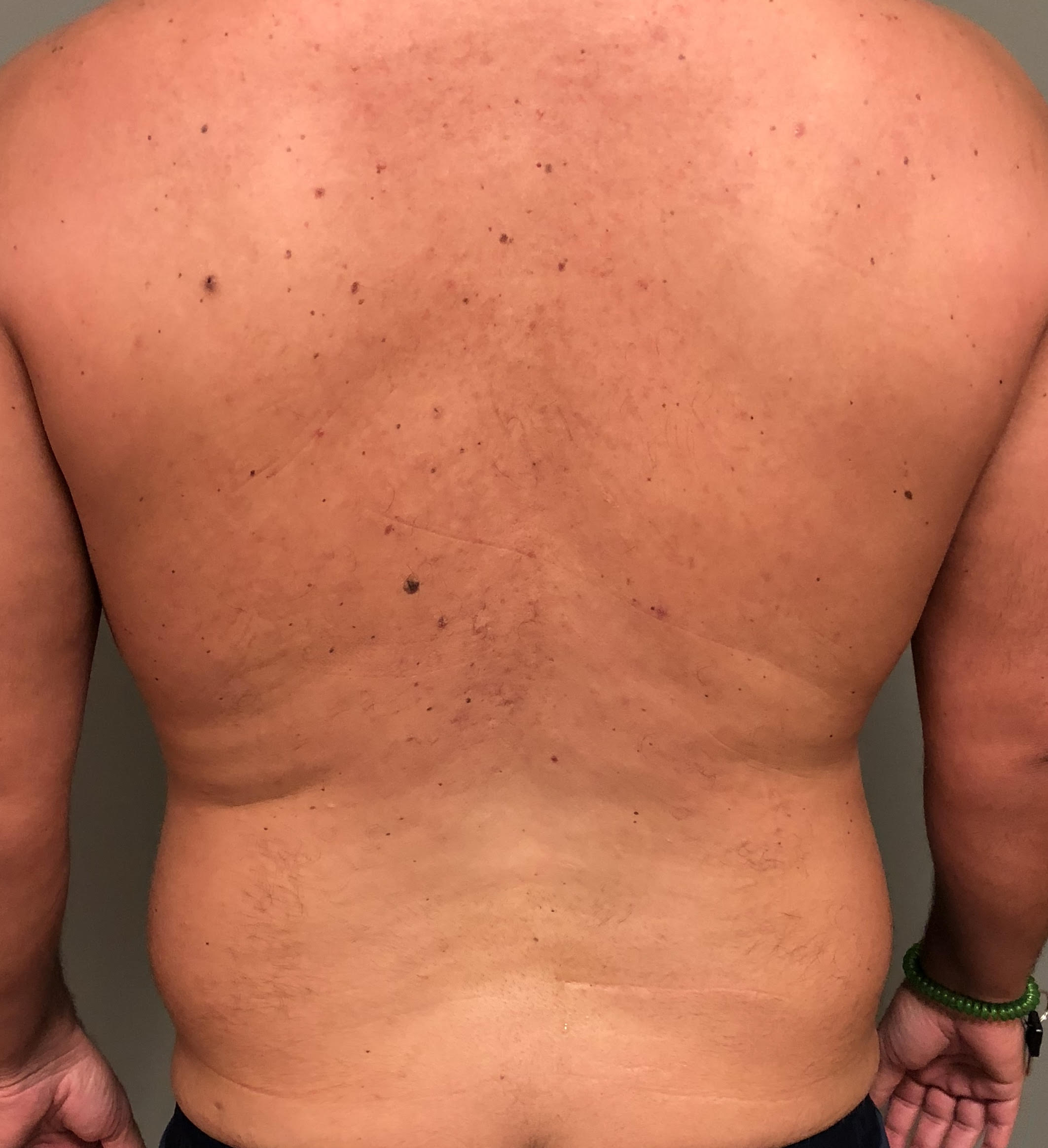 Flanks Before & After Patient #607
