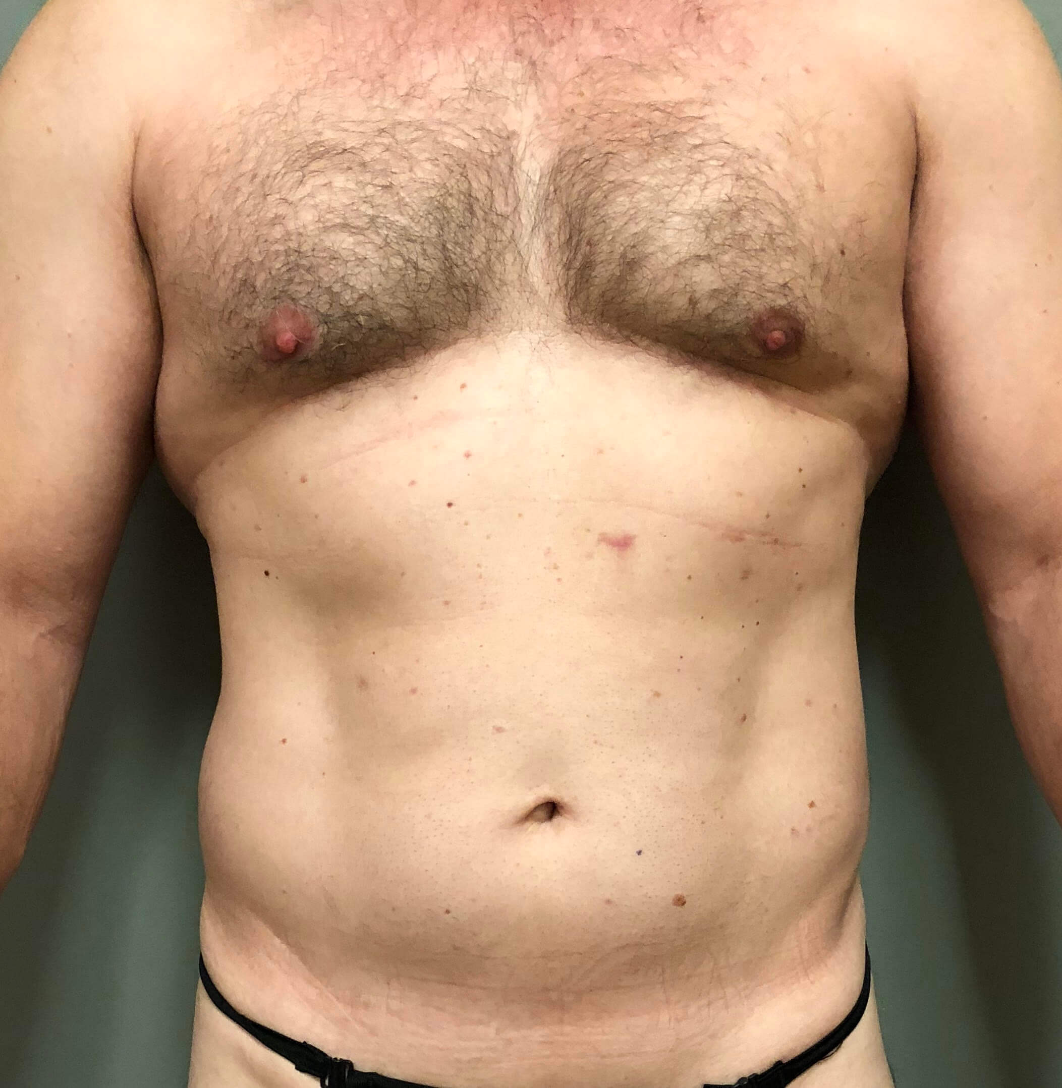 Abdomen Before & After Patient #592