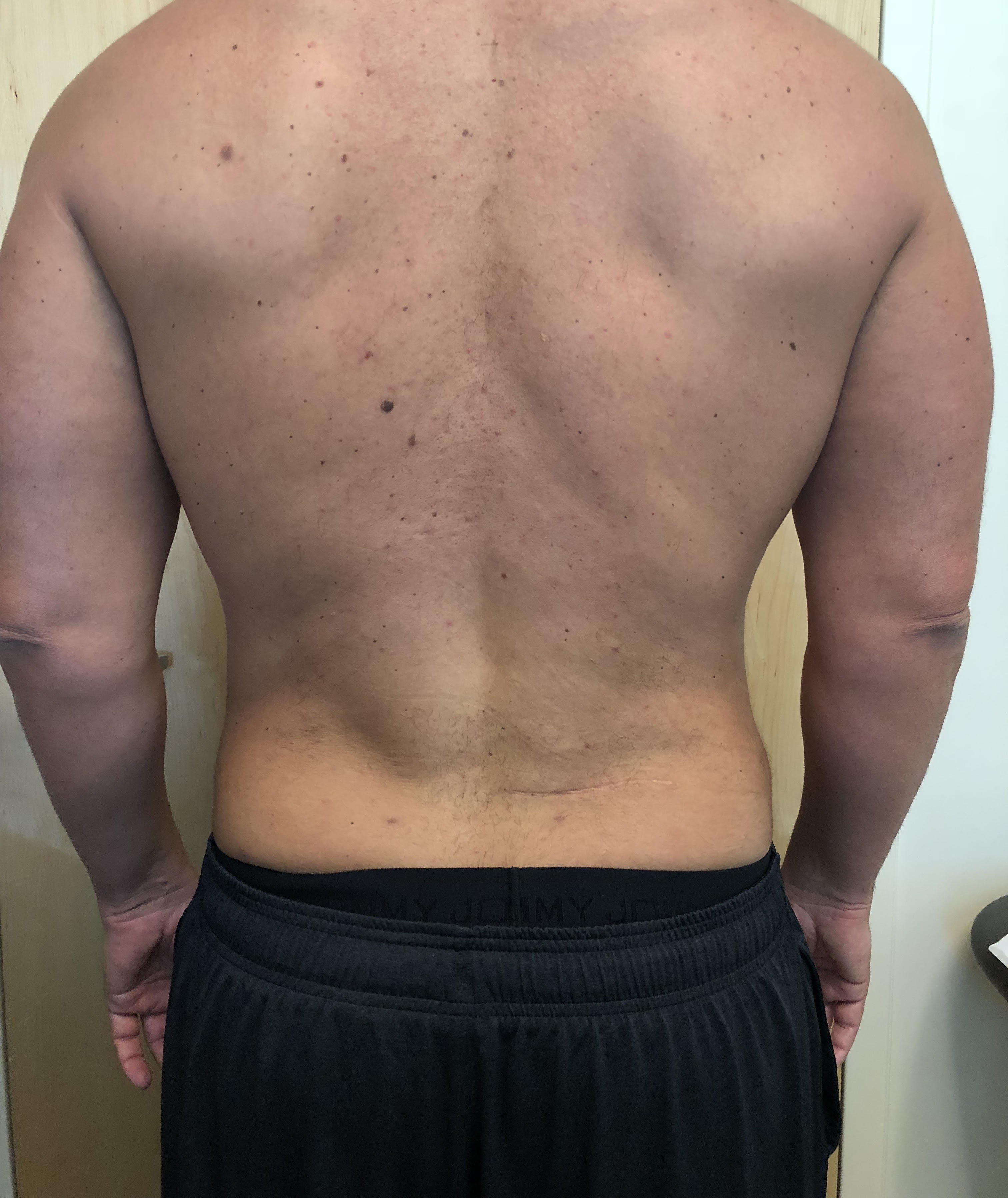 Flanks Before & After Patient #607