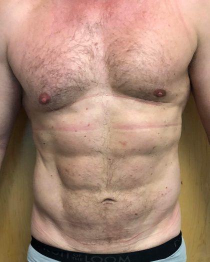 Chest Before & After Patient #592