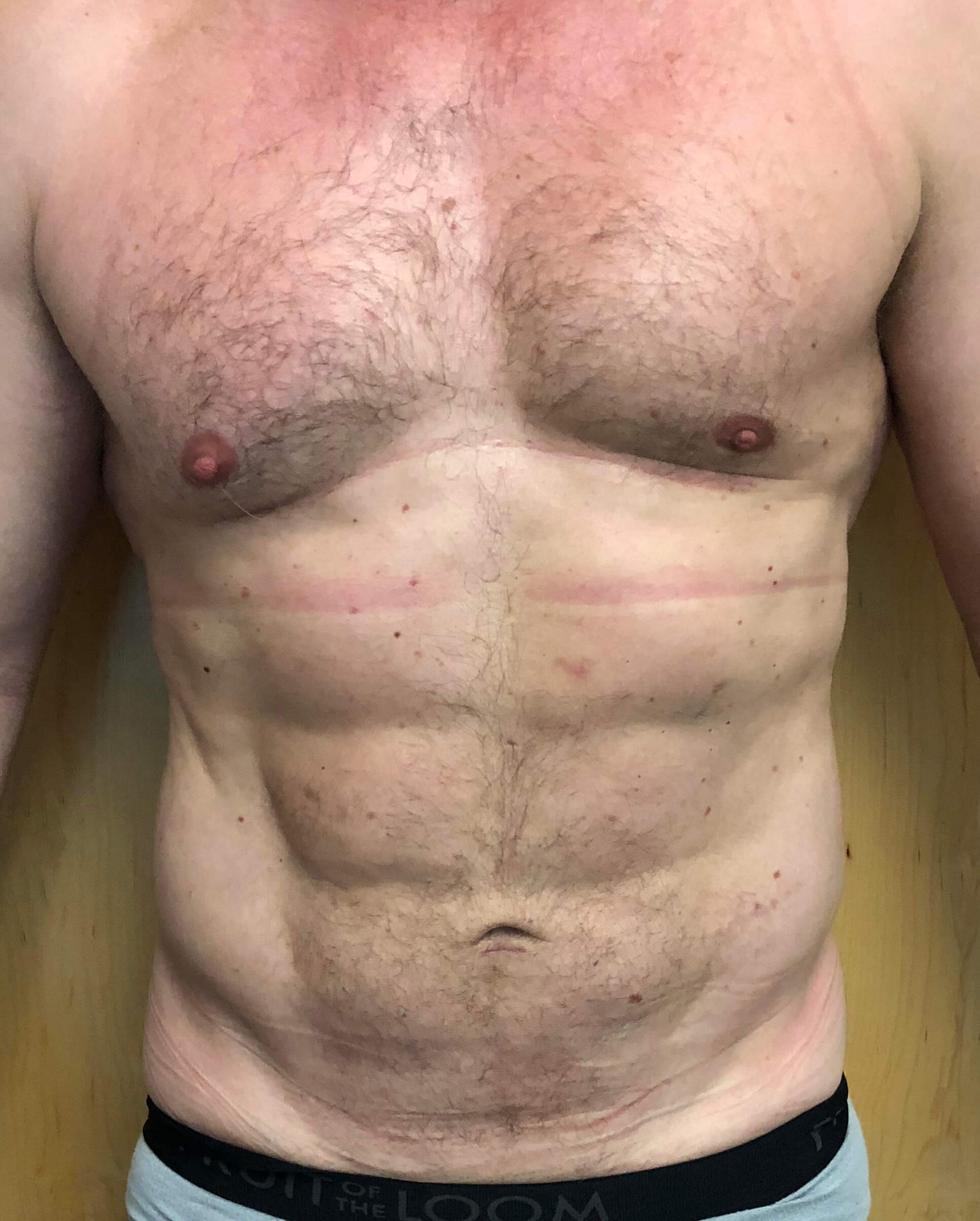 Abdomen Before & After Patient #592