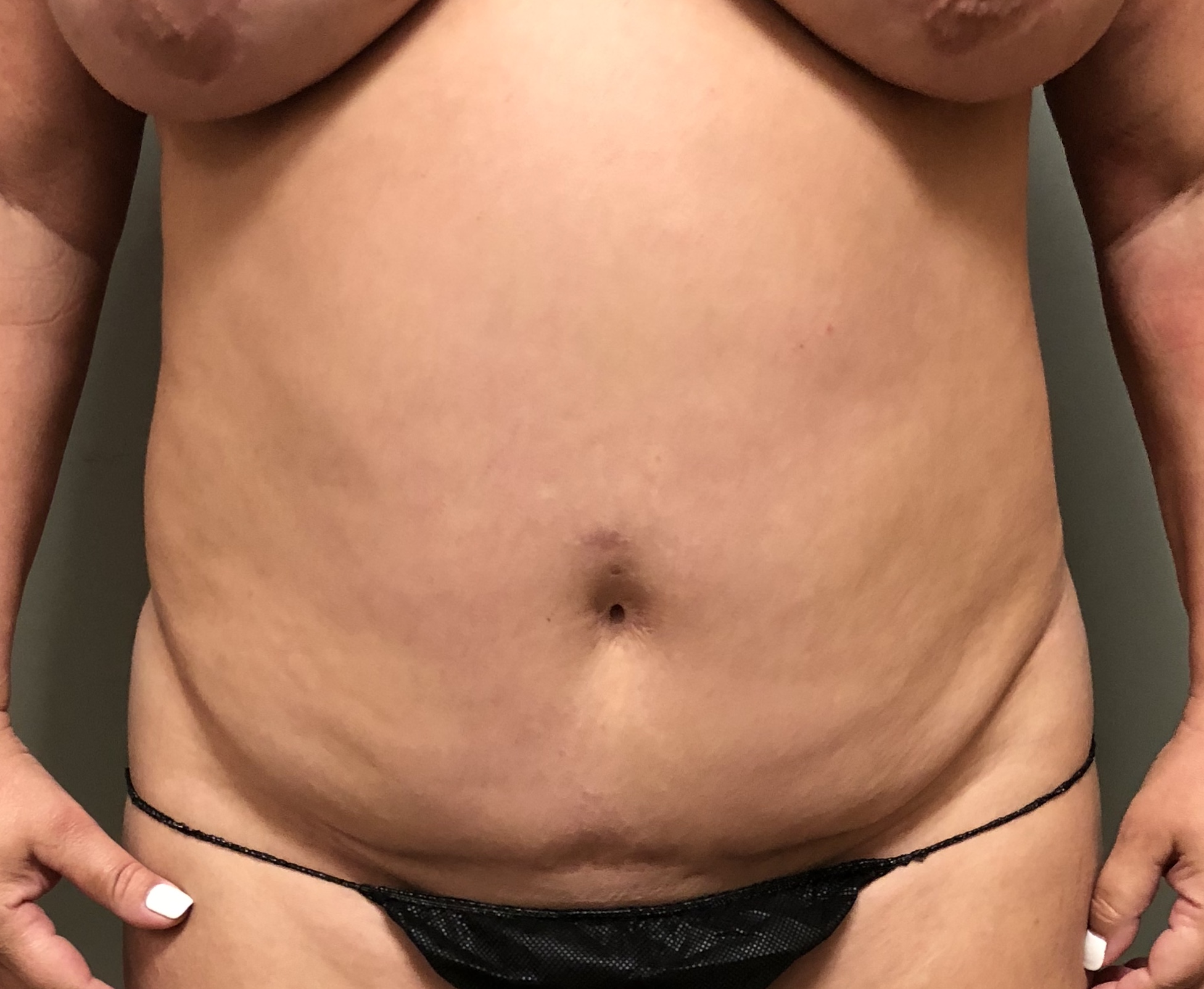 Abdomen Before & After Patient #630